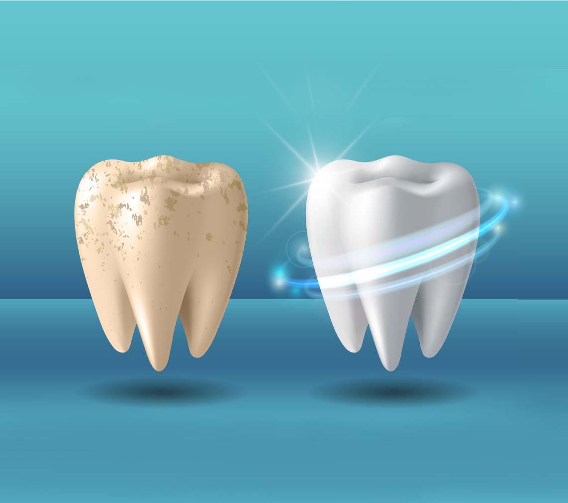 Estella Estetik | Teeth Whitening Why is it so preferred?