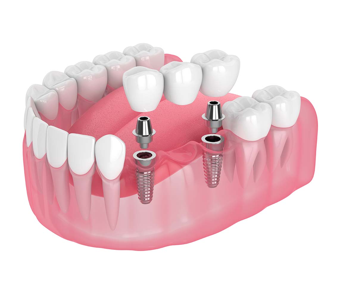 Estella Estetik | Bridge Dental Application Why is it so preferred?