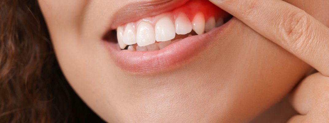 Estella Estetik | Diş Eti Hastalıkları Tanı ve Tedavileri