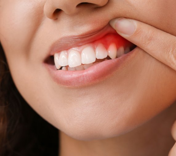 Estella Estetik | Diş Eti Hastalıkları Tanı ve Tedavileri
