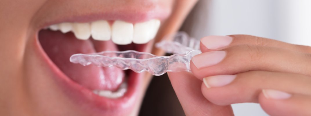 Estella Estetik | Diş Sıkma Tedavisi (Bruksizm)